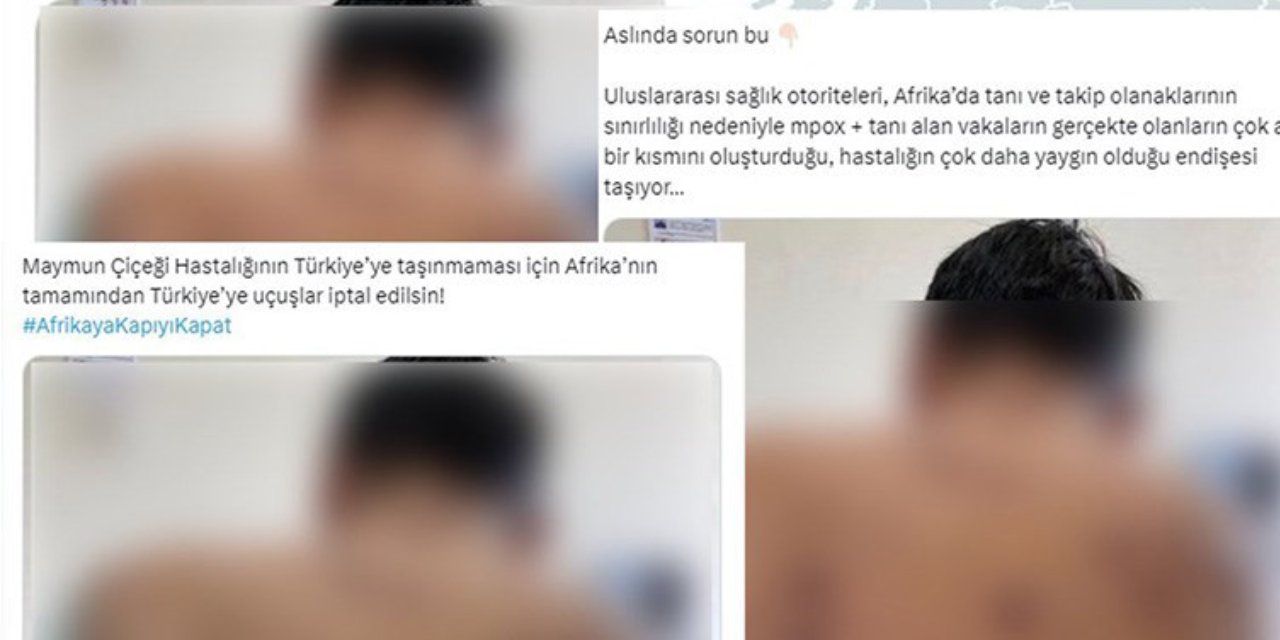 Dezenformasyonla Mücadele Merkezi'nden Maymun Çiçeği Virüsü Açıklaması