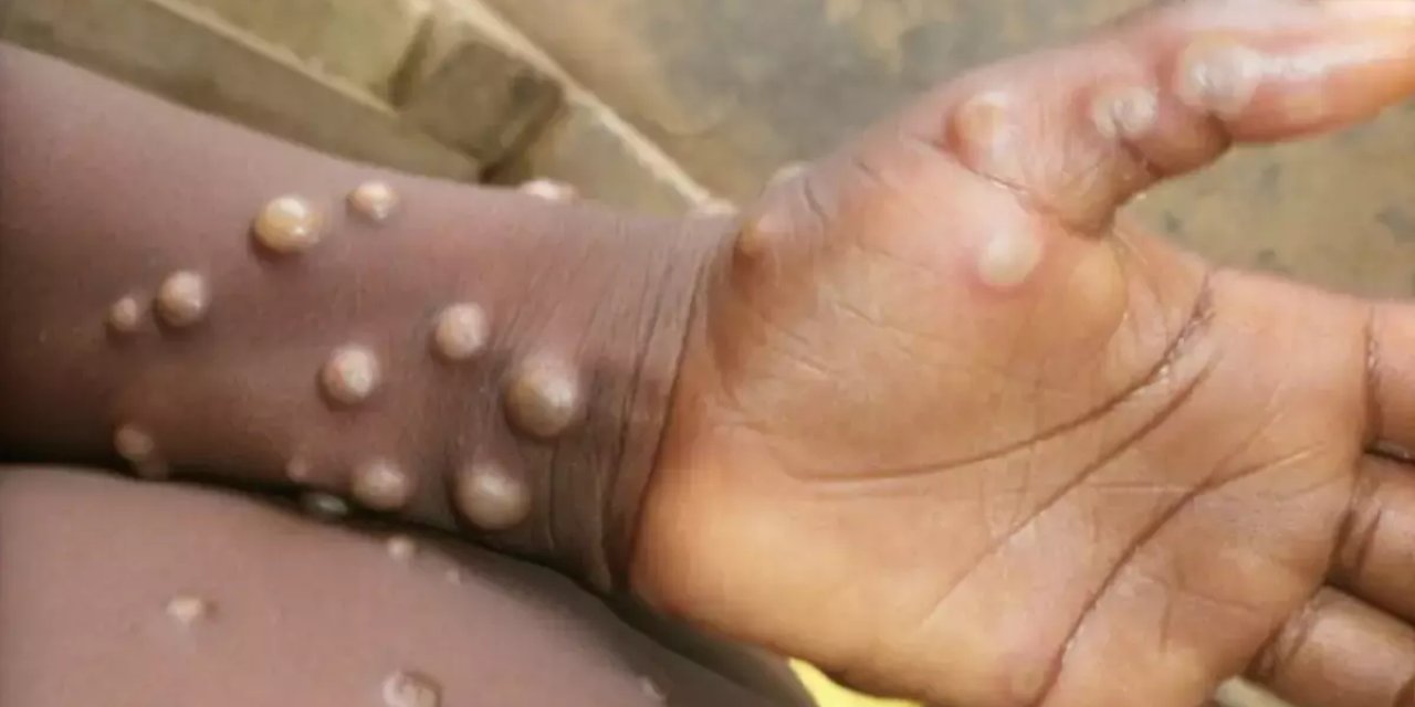 Pakistan'da Mpox Salgını: Yeni Vakalar Tespit Edildi